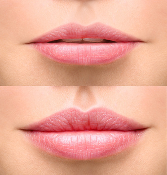 1x Beautiful Lips durch Hyaluron